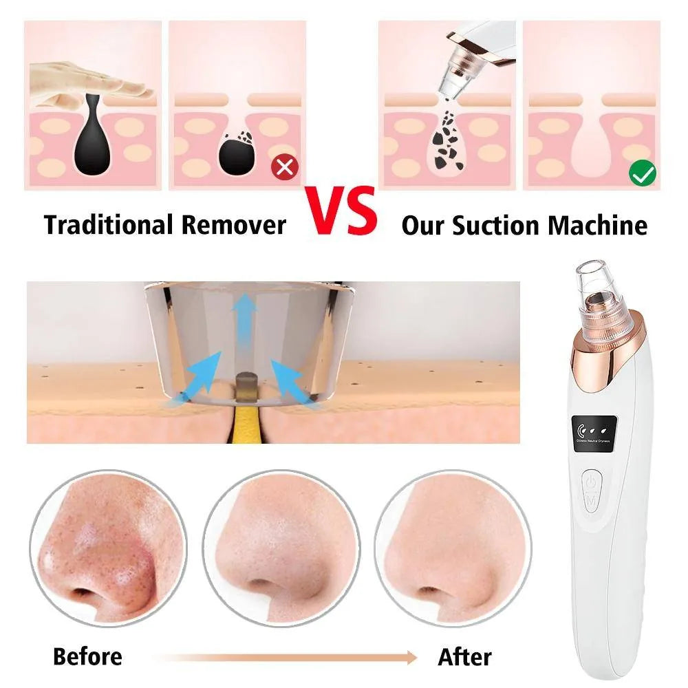 Rechargeable Vacuum Cleans Pores, Removes Blackheads